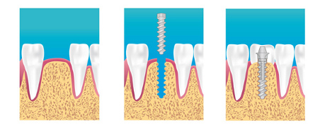 implants dentaires pontoise